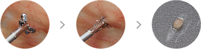 Biopsy Forceps